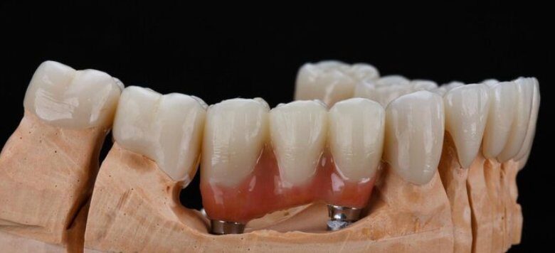 Premium ceramic bridge on implant abutments